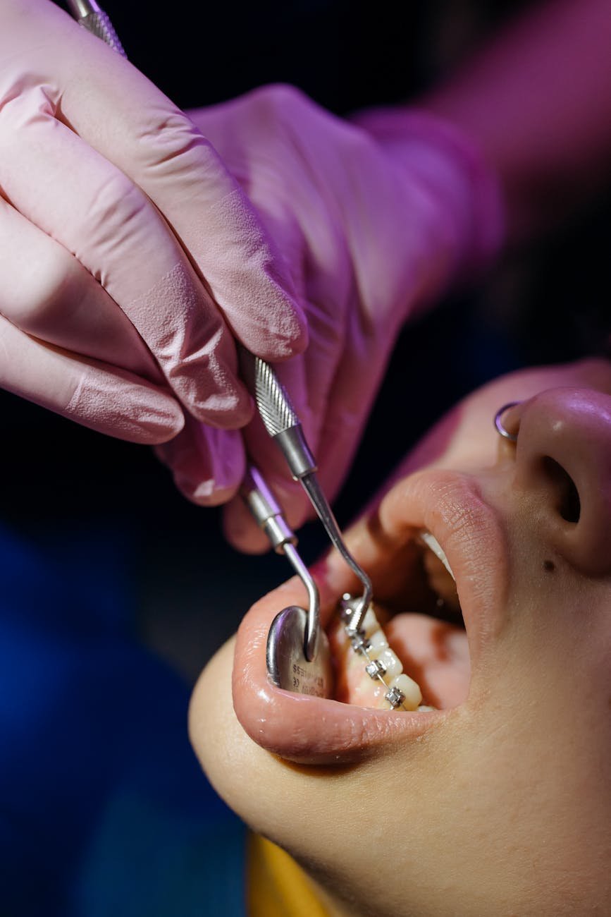 Braces Treatment at Best Smiles Dental Care Tarnaka for a Perfect Smile in Tarnaka Hyderabad illustration for Braces Treatmen